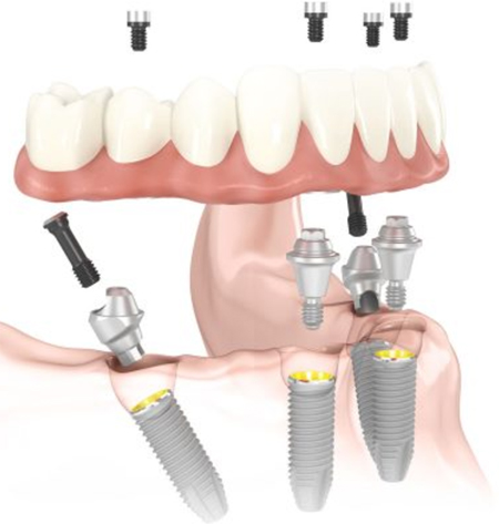 Diagram of All-on-4 dental implants. At the top of the diagram is a denture base with four screws hovering above it. The denture base is suspended above a jawbone, where four dental implant screws are in place; from My Smile Artist in San Antonio