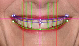 Lips-and-teeth photo of a patient's smile with diagonal and vertical, green, pink, and red lines through it for determining tooth position and facial symmetry for Digital Smile Design, which is available in San Antonio at My Smile Artist.