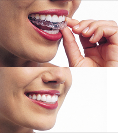 candid clear aligners price